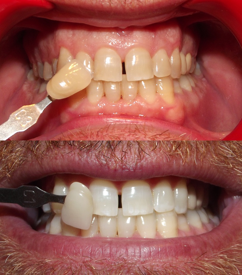 Εικόνα που δείχνει πριν και μετά τις εικόνες λεύκανσης. Τα δόντια πριν είναι κίτρινα και μετά τη λεύκανση είναι λευκά.